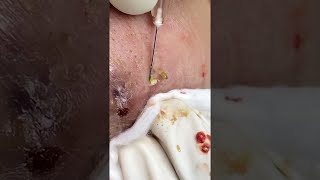 Big Cystic Acne Blackheads Extraction Blackheads amp Milia Whiteheads Removal Pimple Popping shorts [upl. by Kirchner]