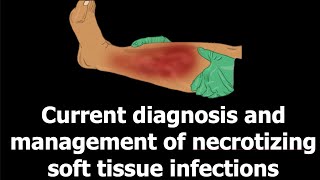 Current diagnosis and management of necrotizing soft tissue infections [upl. by Melisenda]