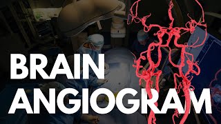 Angiogram  BRAIN angio procedure video [upl. by Benji]