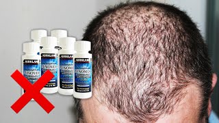 Dont Use MINOXIDIL Before Watching This – It Does NOT Prevent Hair Loss [upl. by Anoiek284]