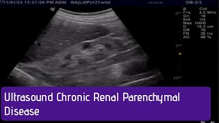 Ultrasound  How to Diagnose Chronic Renal Parenchymal Disease [upl. by Weisbrodt]