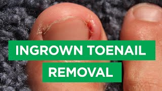 Ep 59 Ingrown Toenail Removal Procedure  The Scope [upl. by Nais]