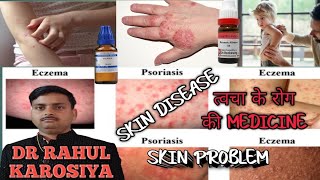 Skin disease skin problem Best Homeopathic Medicines eczema [upl. by Zia799]