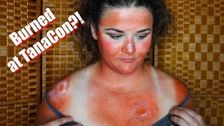 I GOT BURNT AT TANACON  SUNBURN SFX MAKEUP TUTORIAL [upl. by Vaenfila]