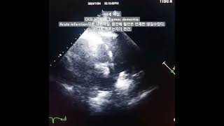 RPA thrombus [upl. by Sergo]