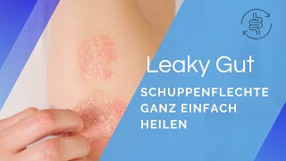 Schuppenflechte ganz einfach heilen  Darm gesund  Mensch gesund  André Blank – Vivoterra® [upl. by Refinej]