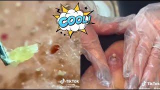 Ultimate Satisfying Acne Removal Compilation Best Pimple Pops Blackheads and Cysts [upl. by Akkim257]