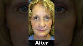 Brow Lift Rhinoplasty Facelift  60 Year Old Patient facelift [upl. by Anawak]