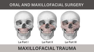 Maxillofacial Trauma [upl. by Ayoj268]