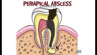 Periapical Abscess [upl. by Ainsley567]