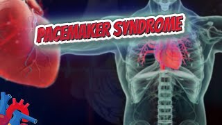 Pacemaker syndrome  Human Heart and Cardiology ❤️❤️❤️🔊✅ [upl. by Aiciram]