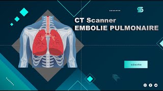 CT Scanner EMBOLIE PULMONAIRE  Partage de pratiques [upl. by Aiotal848]