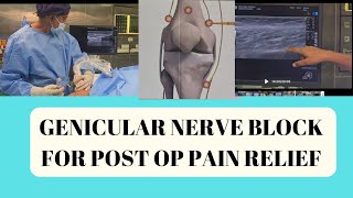 Ultrasound guided genicular nerve block for knee osteoarthritis in Chennai [upl. by Teleya]