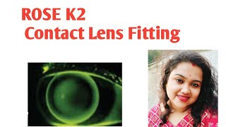 ROSE K2 Contact lens fitting basics for mild to moderate Keratoconus [upl. by Drisko]