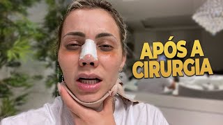 FIZ RINOPLASTIA  COMO FICOU VIVI WINKLER [upl. by Joses]