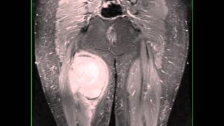 Synovial Sarcoma Thigh [upl. by Anividul41]