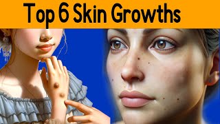 Top 6 six skin growths From Moles to Warts  A Complete Guide [upl. by Panta429]