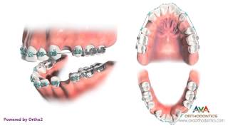 Orthodontic Treatment for Excessive Lip Support  Removing 4 Premolars [upl. by Bainbrudge524]