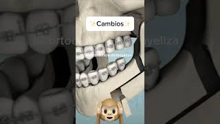 Skeletal Class III malocclusion Orthognatic surgery orthodontics orthodontist orthognaticsurgery [upl. by Burgener]