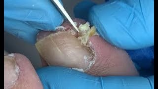 Remove old skin for nails [upl. by Lambart]