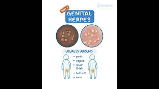 Genital Herpes [upl. by Wampler]