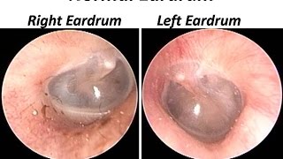 The Normal Eardrum  Otoendoscopy view [upl. by Macswan]