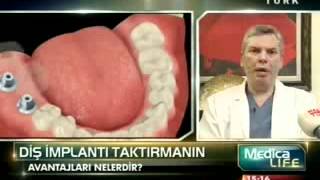 implant nedir  diş implantı taktırmanın avantajları nelerdir  Tanfer Klinik [upl. by Wichern]