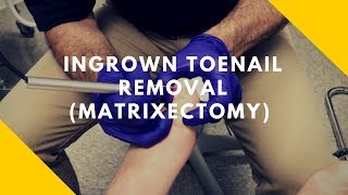 Ingrown Toenail Removal Matrixectomy [upl. by Sheply]