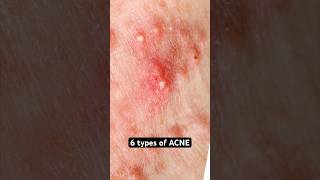 6 Types of Acne Explained shorts acne [upl. by Yanrahs884]