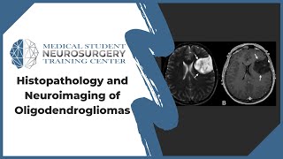 Histopathology and Neuroimaging of Oligodendrogliomas [upl. by Photima]