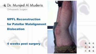 MPFL Reconstruction for Patellar Malalignment Dislocation  4 weeks post surgery [upl. by Tollmann]