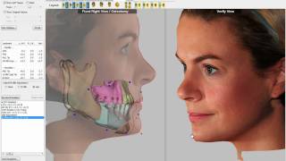 3D Visual Treatment Objective VTO Software Demo [upl. by Okoyk]