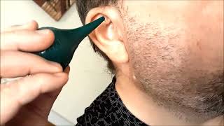 EAR WAX REMOVAL at HOME How to Use Hydrogen Peroxide Solution Homemade Mix to REMOVE Clean Buildup [upl. by Brout259]