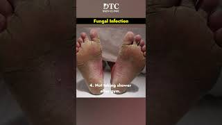 What is Fungal Infection amp Its Treatment  DTC Skin Clinic [upl. by Petey]