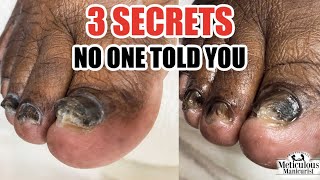 Nail Fungus Cure 3 Secrets to Total Relief [upl. by Ymar]