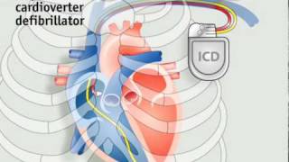 How pacemakers work [upl. by Ferullo]