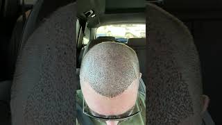 Hair Transplant in Turkey  Hair Transplant before after hairtransplant [upl. by Eenal594]