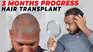 Hair Transplant in Muzaffarpur  Best Results amp Cost of Hair Transplant in Muzaffarpur [upl. by Kubetz688]