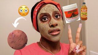 I Used The Aztec Healing Clay Mask On My Skin Everyday For One Week [upl. by Yaj]