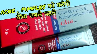 Clid gel for acne uses in hindi  clindamycin amp Nicotinamide gel review in hindi [upl. by Peder]