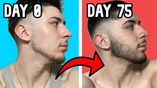 Minoxidil Beard Growth Week 11 [upl. by Mehelhteb910]