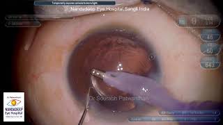 Soft Cataract 4 EDOF IOLs Dr Sourabh D Patwardhancataract phaco patwardhansourabhgmailcom [upl. by Loni511]