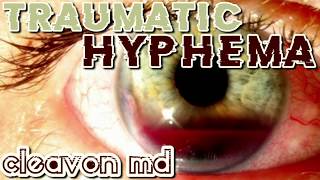 Cleavon MD  Traumatic Hyphema [upl. by Papp]