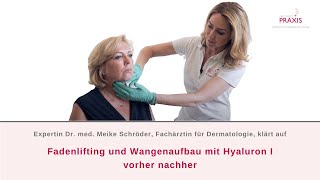 Fadenlifting und Wangenaufbau mit Hyaluron I Vorher Nachher [upl. by Rowney]