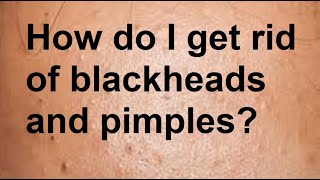 How do I get rid of blackheads and pimples [upl. by Haral]