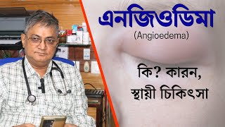 What is Angioedemaএনজিওডিমা in Bengali এনজিওইডিমা কি angioedema causes symptom treatment [upl. by Euqinomod843]