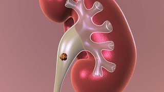 Observation Nonsurgical Approach to Kidney Stones [upl. by Ellemrac92]