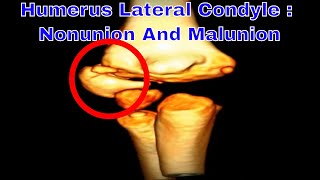 Humerus Lateral Condyle Nonunion And Malunion [upl. by Yntirb546]