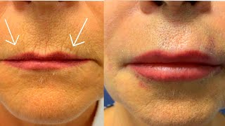 How to Get Rid of Wrinkles around Lips💋How to Get Plump LipsBiggerLipsFuller Lips [upl. by Alick]