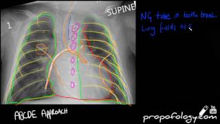 Abnormal Tube in Chest Xray 4 Minutes Radiology [upl. by Hubey]